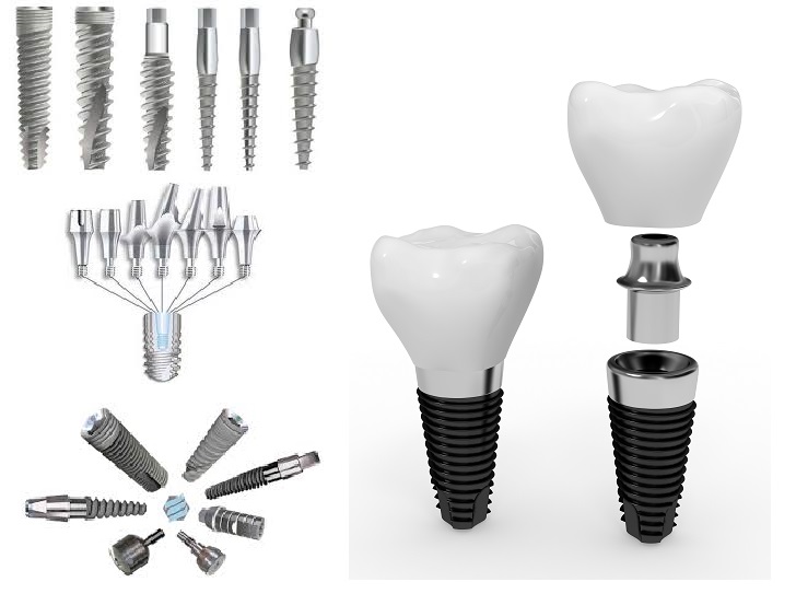 implant_1.jpg