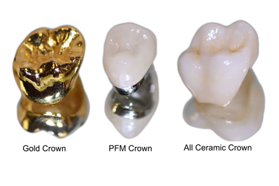 Crowns